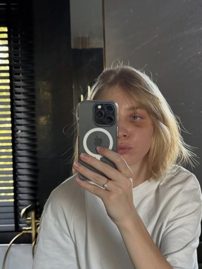 Kamila Sellier po rekonstrukcji oczodołu