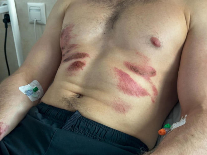 Ratownicy rozjechali biegacza? Dramat podczas półmaratonu w Ostródzie