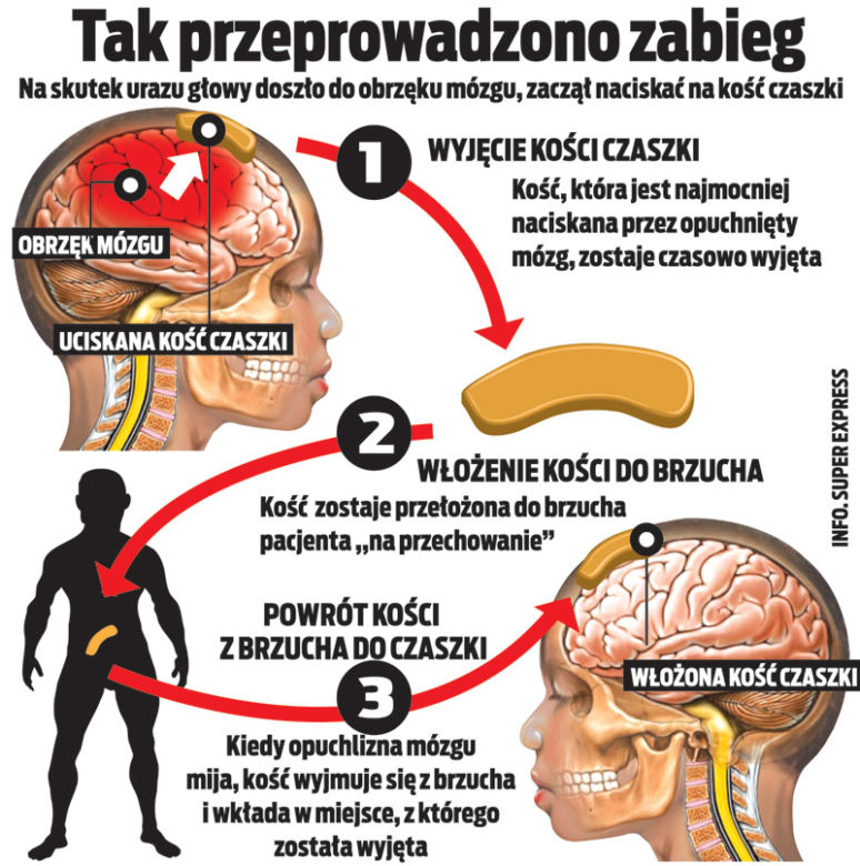 Wszczepili mu głowę w brzuch