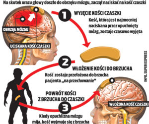 Wszczepili mu głowę w brzuch