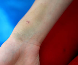 Niezwykła operacja w prokocimiu. Lekarze uratowali serce Zuzi