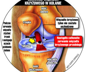 Bolesny upadek Petru na nartach
