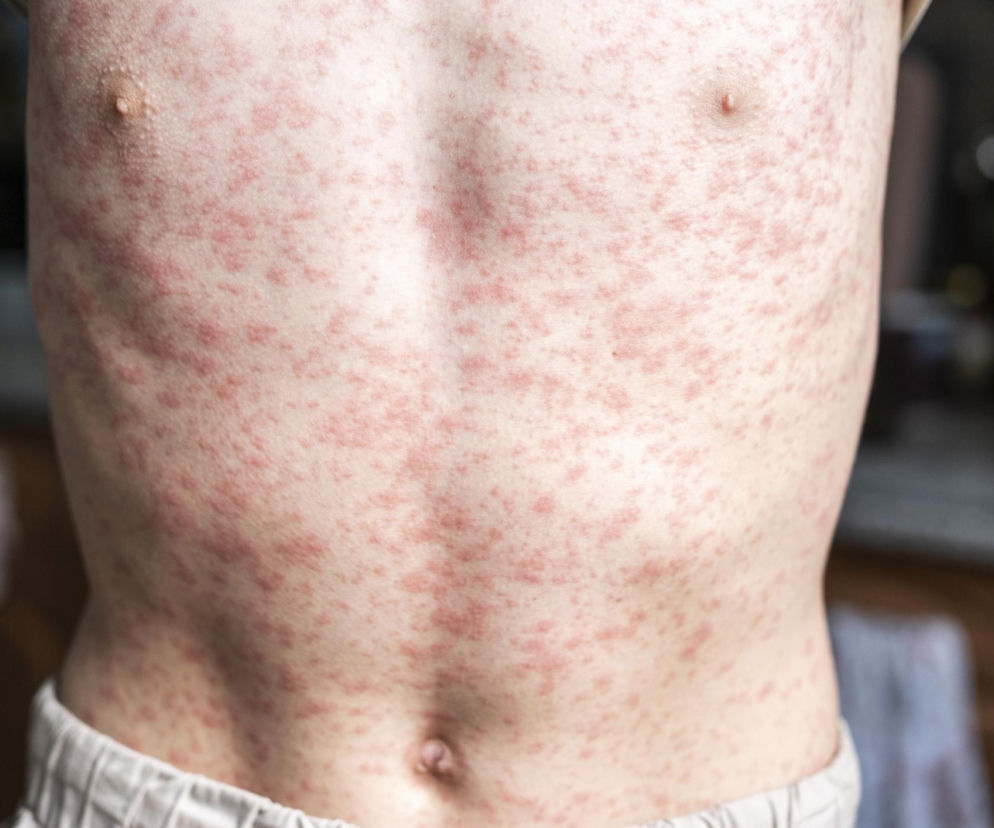 Tułów dziecka pokryty czerwoną wysypką, symptomem odry. Zdjęcie ilustruje poważne zagrożenie powrotem wirusa, o którym przeczytasz na Poradnik Zdrowie, podkreślając znaczenie szczepień.