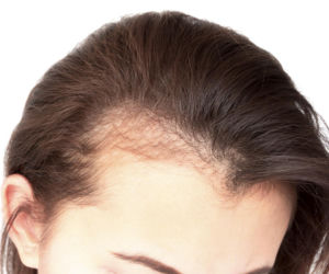 Wcieraj w skórę głowy w każdy czwartek. Zakola znikną, a włosy zaczną zagęszczać się jak szalone. Domowa maska na wypadające włosy