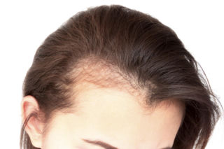 Wcieraj w skórę głowy w każdy czwartek. Zakola znikną, a włosy zaczną zagęszczać się jak szalone. Domowa maska na wypadające włosy