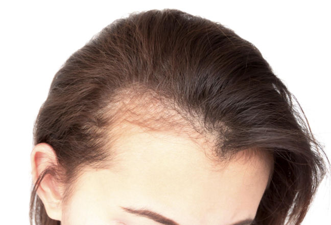 Wcieraj w skórę głowy w każdy czwartek. Zakola znikną, a włosy zaczną zagęszczać się jak szalone. Domowa maska na wypadające włosy