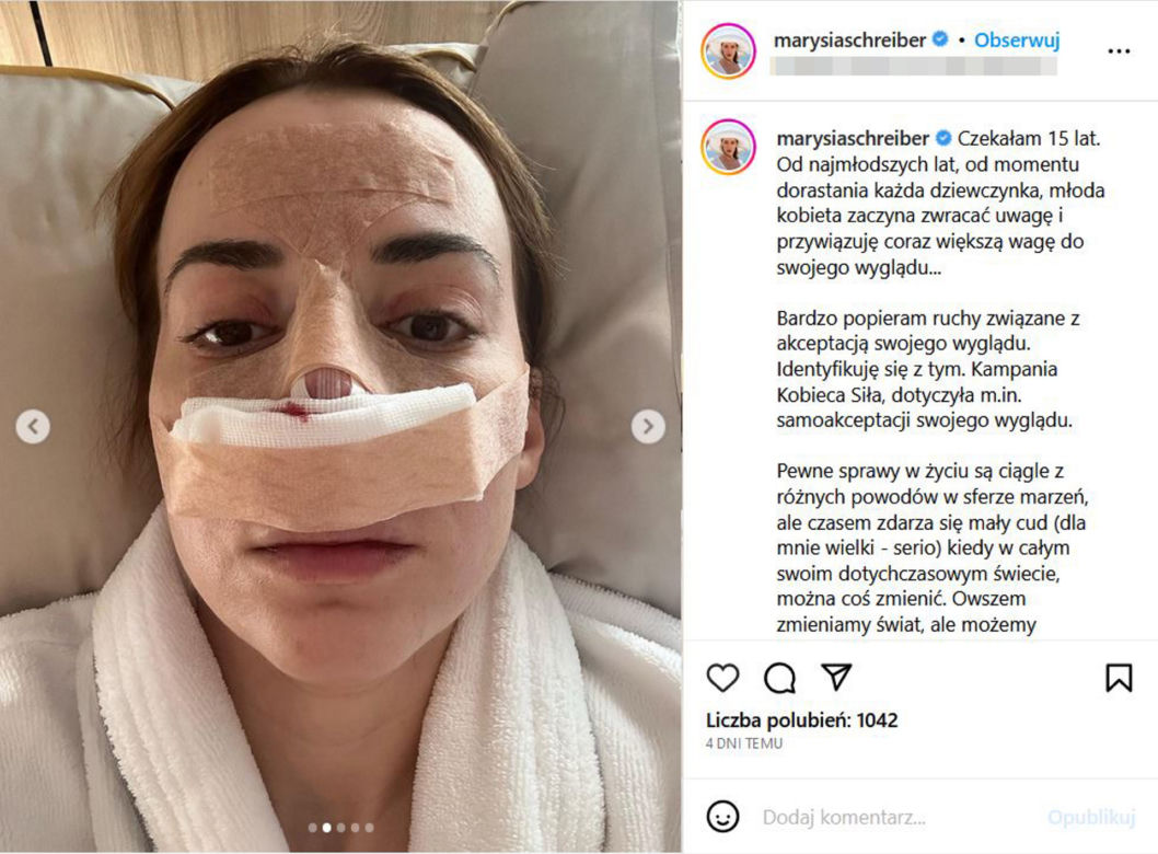 Tak wygląda Marianna Schreiber po operacji nosa