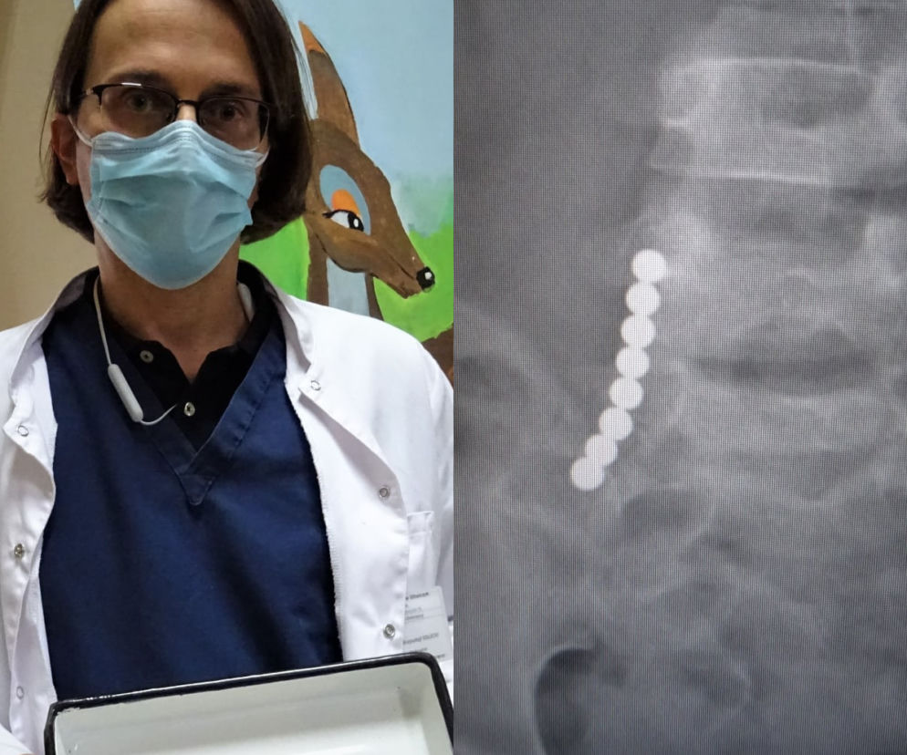 O krok od tragedii. 4-letnia dziewczyna połknęła kulki magnetyczne. Uratowali ją chirurdzy z Gliwic