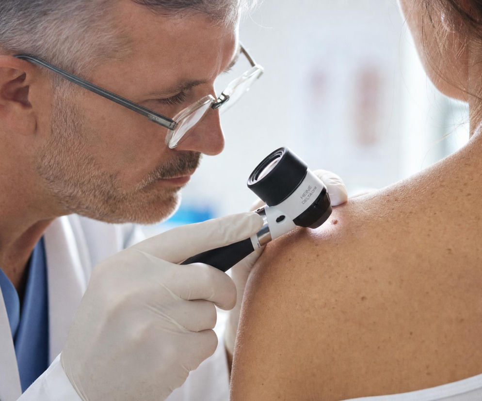 Lekarz w okularach bada dermatoskopem pieprzyk na plecach pacjentki. O dermatoskopii przeczytasz na Poradnik Zdrowie.