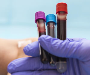 Nadzieja dla pacjentów. Nowy test krwi wykrywa raka trzustki we wczesnym stadium