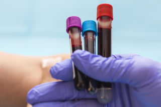 Nadzieja dla pacjentów. Nowy test krwi wykrywa raka trzustki we wczesnym stadium