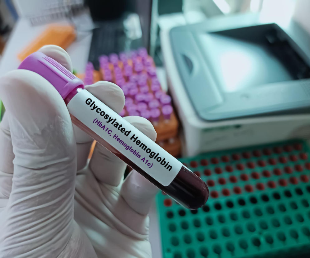 Dłoń w białej rękawiczce trzyma probówkę z próbką krwi do badania hemoglobiny glikowanej, co odnosi się do artykułu na Poradnik Zdrowie o wpływie niskiego poziomu hemoglobiny na zdrowie, w tym metabolizm glukozy i układ sercowo-naczyniowy.