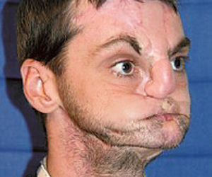 Przeszczep twarzy