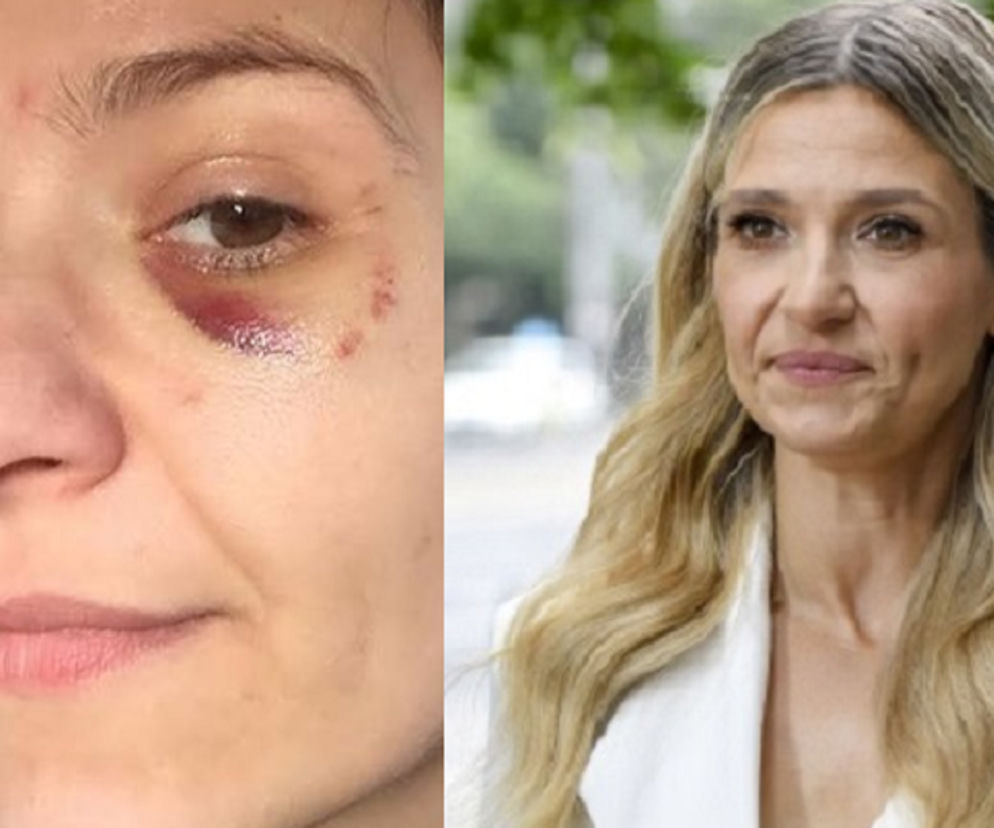 Joanna Koroniewska z siniakiem pod okiem