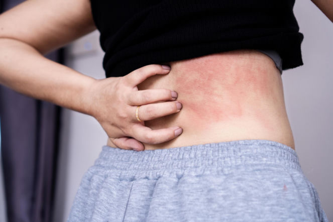 Alergia skórna zaczyna się od tych objawów. Wysypka i świąd mają podobne przyczyny