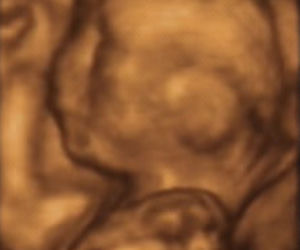 20 tydzień ciąży - zdjęcie USG