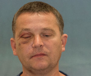 Wydrukowali mu nowe kości twarzy