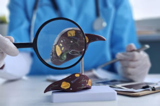 Niepozorne zakażenie może zniszczyć chorą wątrobę. HEV wciąż wymyka się diagnostyce