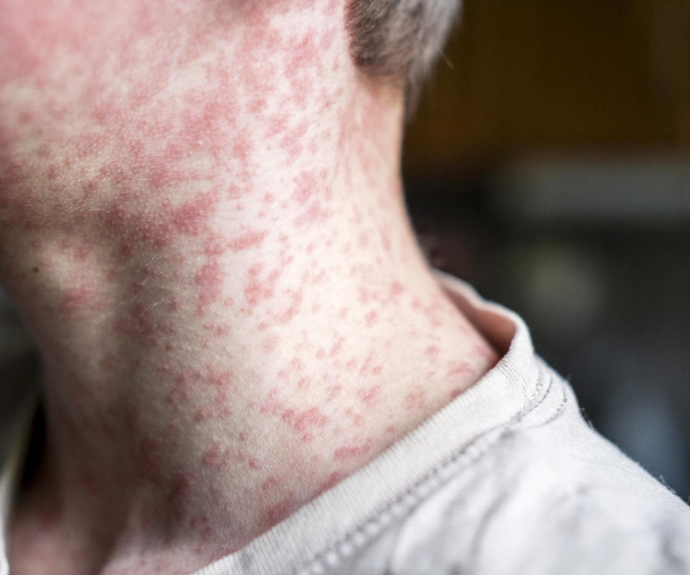 Zapomniany wirus atakuje Podkarpacie. Odra Resetuje układ odpornościowy, który potrzebuje roku, by się odbudować