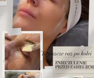Rozenek razi twarz prądem