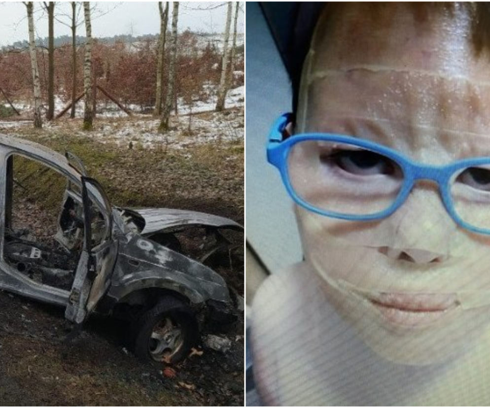 Auto spłonęło, 10-latek ciężko poparzony. Jego ciało pokryły przerażające blizny! [DRASTYCZNE ZDJĘCIA]