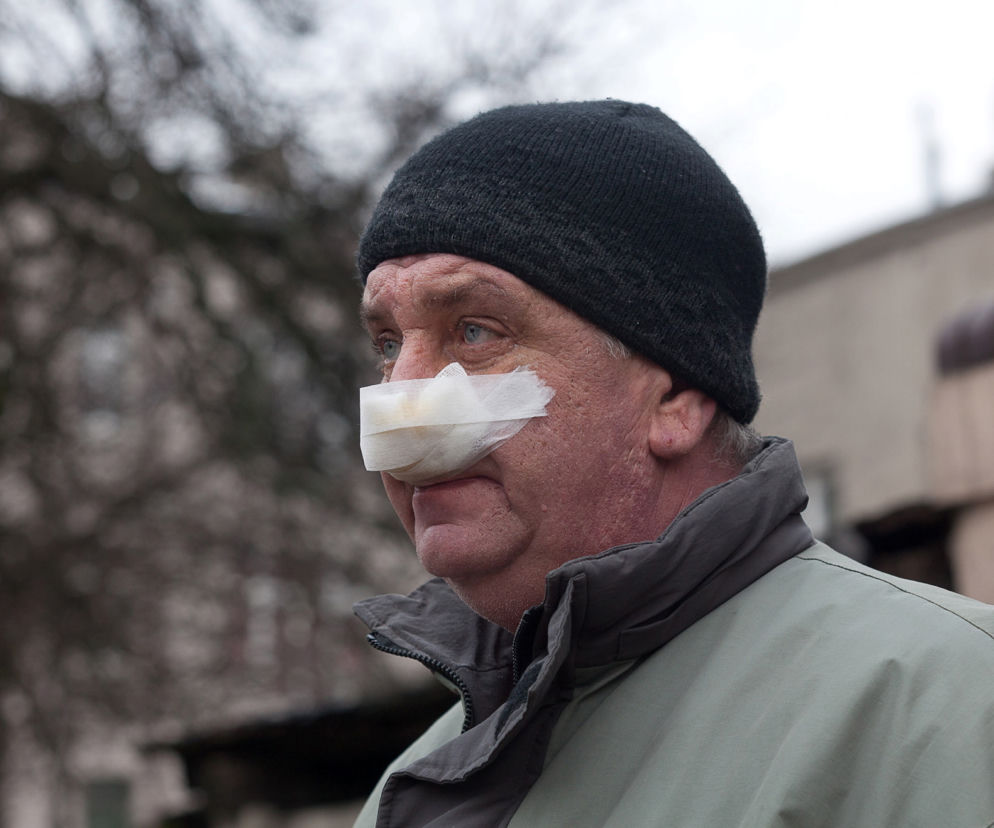 Kanibal odgryzł mi nos