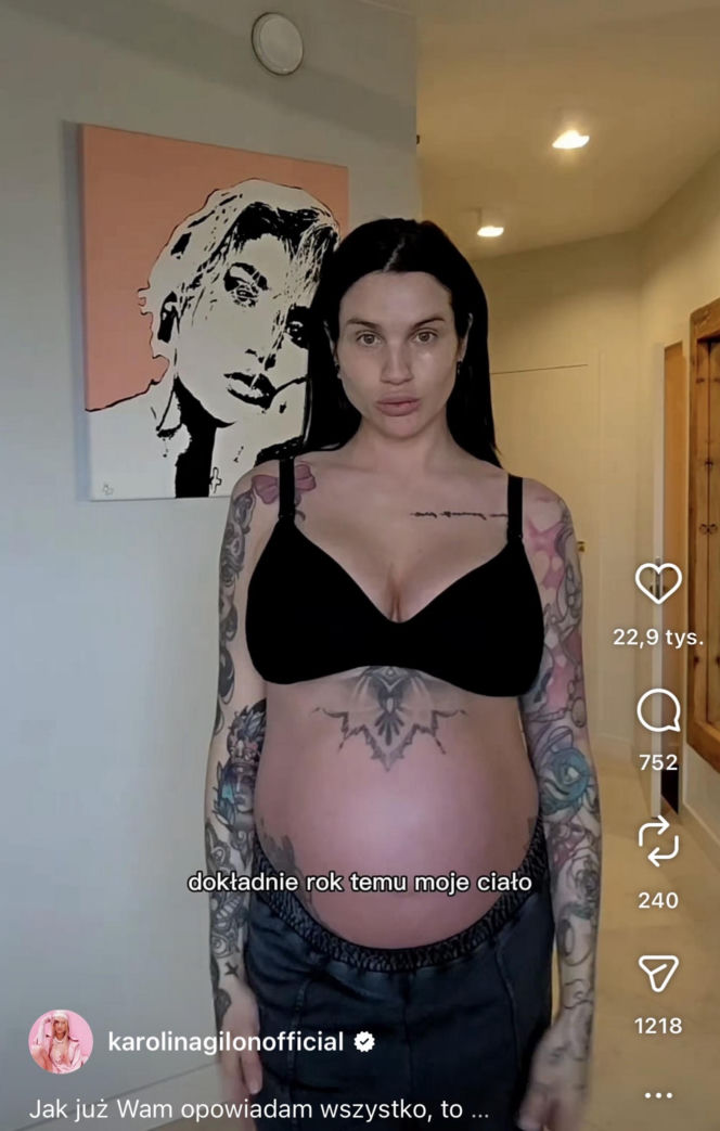 Karolina Gilon zoperowała biust. Zdjęcia przed i po