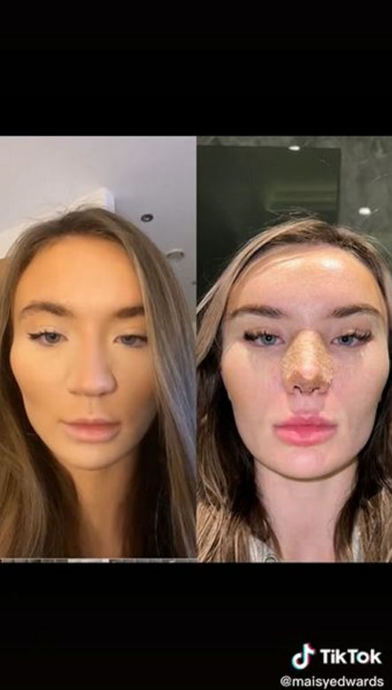 Znana influencerka pojechała do Turcji "zrobić" sobie nos. Wydała 50 tys. zł, fani bezlitośni: "Jest gorzej"