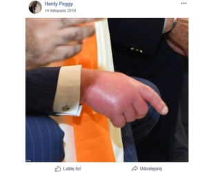 Spuchnięta dłoń księcia Karola