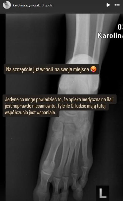 Żona Piotra Adamczyka miała groźny wypadek! Tak się skończył ich wypad na Bali
