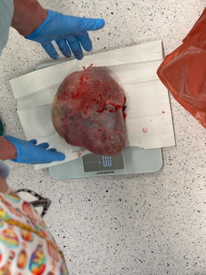 Rekordzista ważył 70! W szpitalu w Lesznie usunięto 11-kilogramowego guza