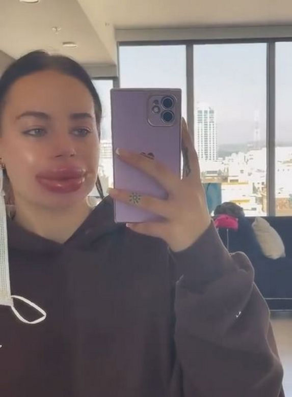 Jej usta prawie wybuchły po darmowym zabiegu. Dramat influencerki. "Najgorszy dzień w życiu"