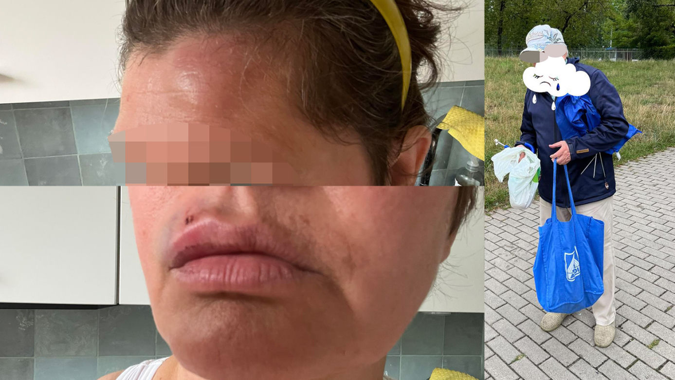 Kobieta pobita przez staruszka, bo zwróciła mu uwagę. "Przewrócił mnie na chodnik i okładał parasolką, potem uderzył pięścią w twarz"