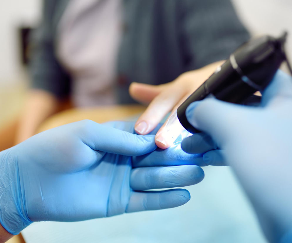 Dermatolog w niebieskich rękawiczkach bada paznokieć pacjenta dermatoskopem, szukając ciemnej smugi lub innych niepokojących zmian. Regularna kontrola stanu paznokci jest kluczowa w profilaktyce czerniaka podpaznokciowego, o którym więcej przeczytasz na Poradnik Zdrowie.