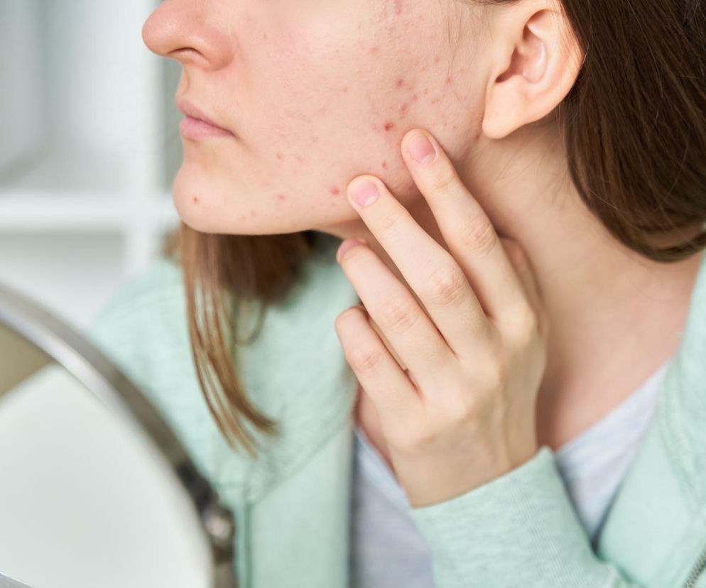 Najczęstsze mity o trądziku, które niszczą Twoją cerę