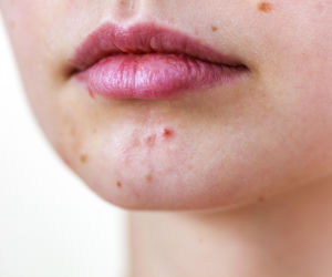 Krostki na brodzie to nie zawsze trądzik hormonalny. Sprawdź, co może je powodować