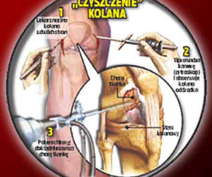 Czyszczenie kolana