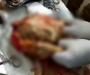 Przypadki „dzieci z kamienia” opisywano już w X wieku