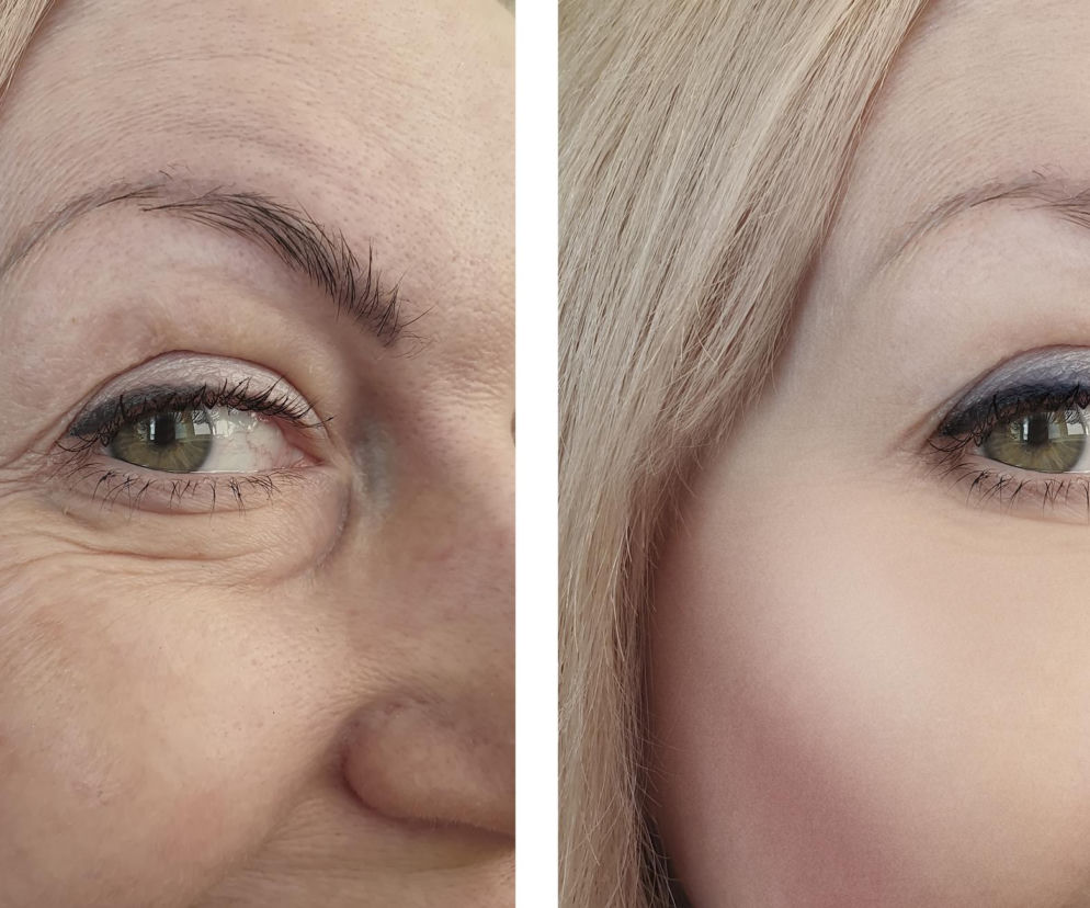 Kurze łapki stają się widoczne? Te składniki w kremach pod oczy naprawdę działają na skórę