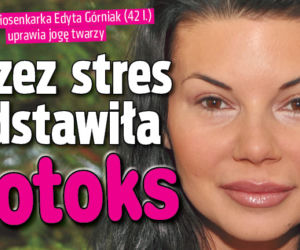 Przez stres odstawiła botoks