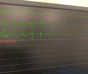Kolejny sukces lekarzy z Gliwic. Wszczepili pacjentowi nowoczesny rozrusznik serca