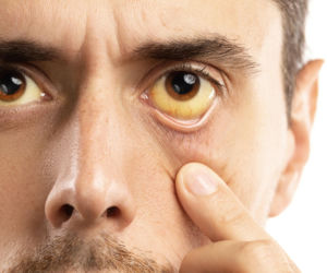 Białka oczu zmieniły kolor? W ten sposób wątroba może wysyłać sygnał alarmowy