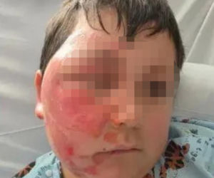 Wsadził do mikrofali plastik, eksplodował mu na twarz. 9-latek oszpecony na zawsze. Nowy niebezpieczny trend