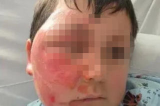 Wsadził do mikrofali plastik, eksplodował mu na twarz. 9-latek oszpecony na zawsze. Nowy niebezpieczny trend