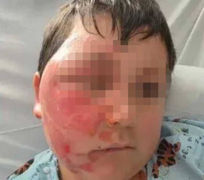 Wsadził do mikrofali plastik, eksplodował mu na twarz. 9-latek oszpecony na zawsze. Nowy niebezpieczny trend