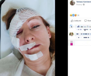 Stary Belęcin: Agresywny pies rzucił się rowerzystkę! POCIĘTA twarz, połamane ręce! [ZDJĘCIA]