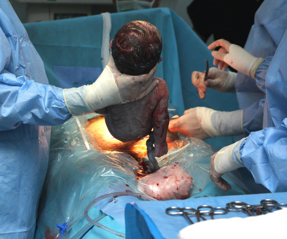 Poród przez cesarskie cięcie