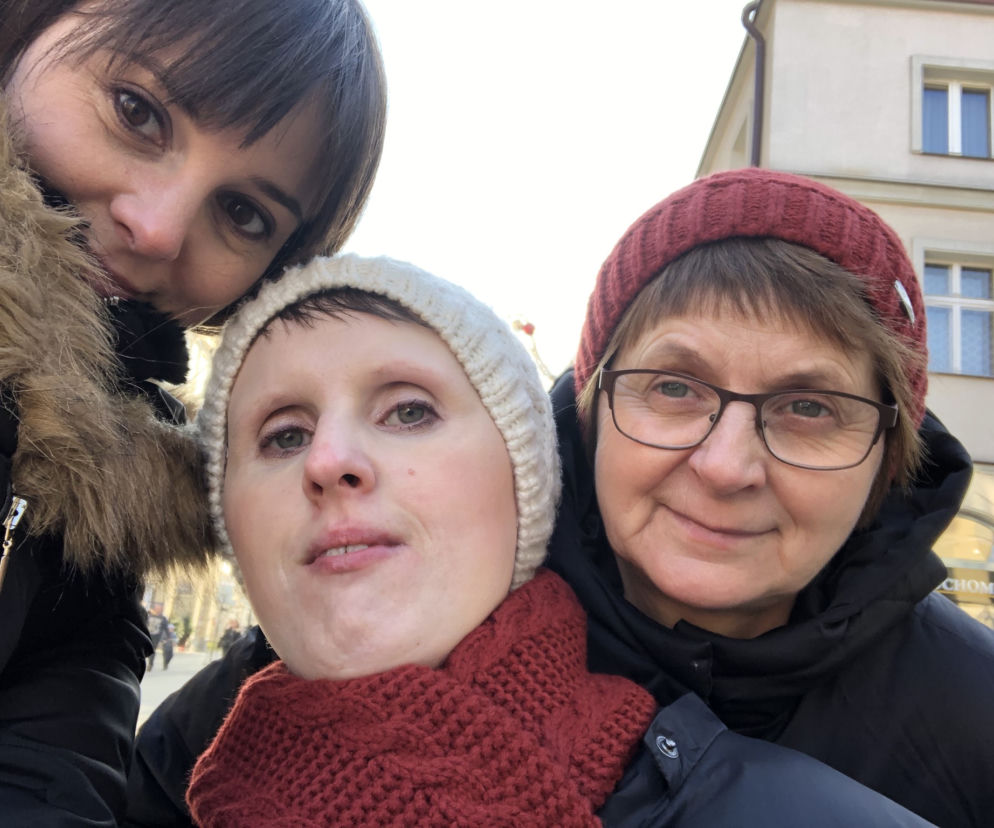 Żyję z fibrodysplazją. Joanna: Moje ciało staje się żywym posągiem
