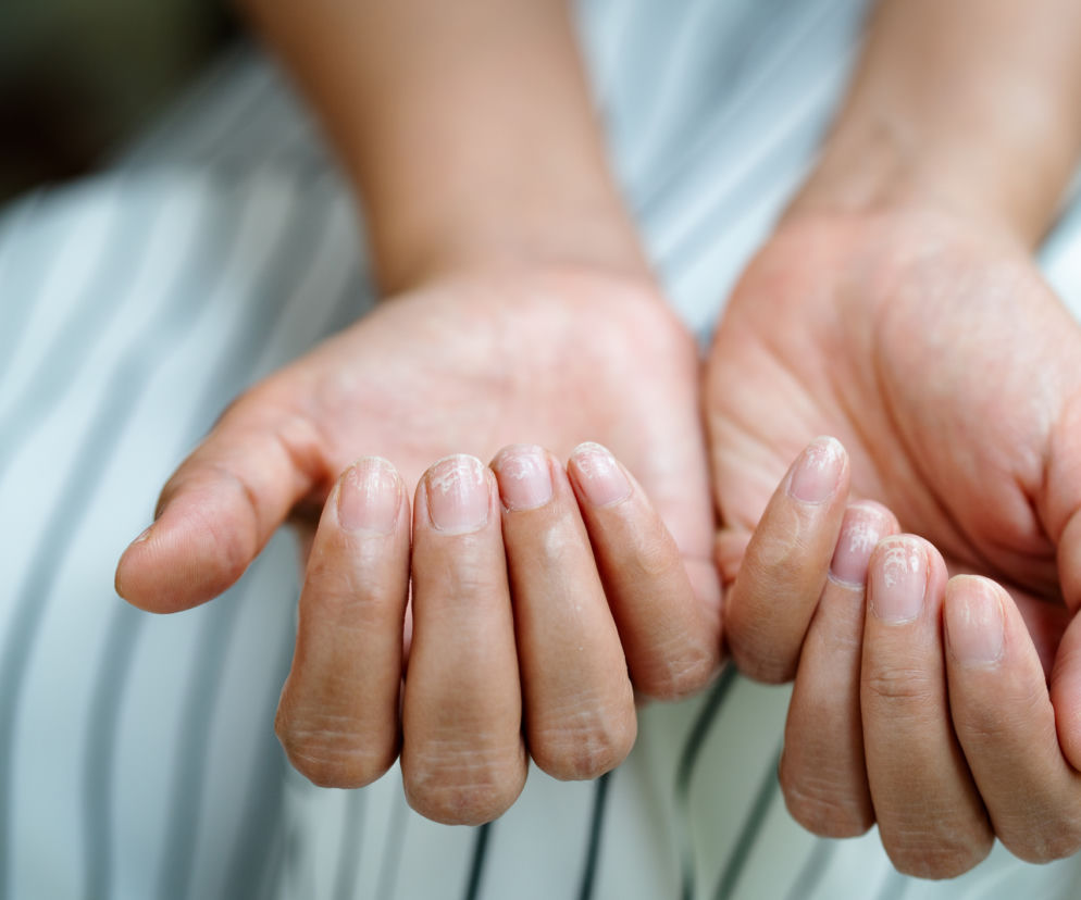 Choroby paznokci - co może być przyczyną problemów z paznokciami?