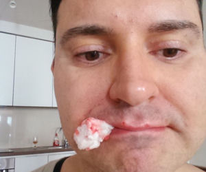 Michał Witkowski wstrzykuje sobie botoks i powiększa usta!